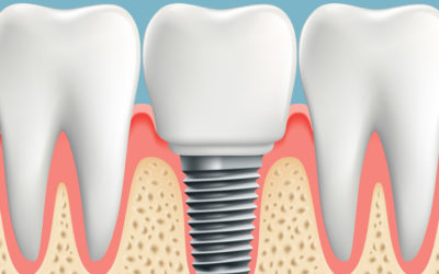 ¿Cuándo decidirse por un implante dental?